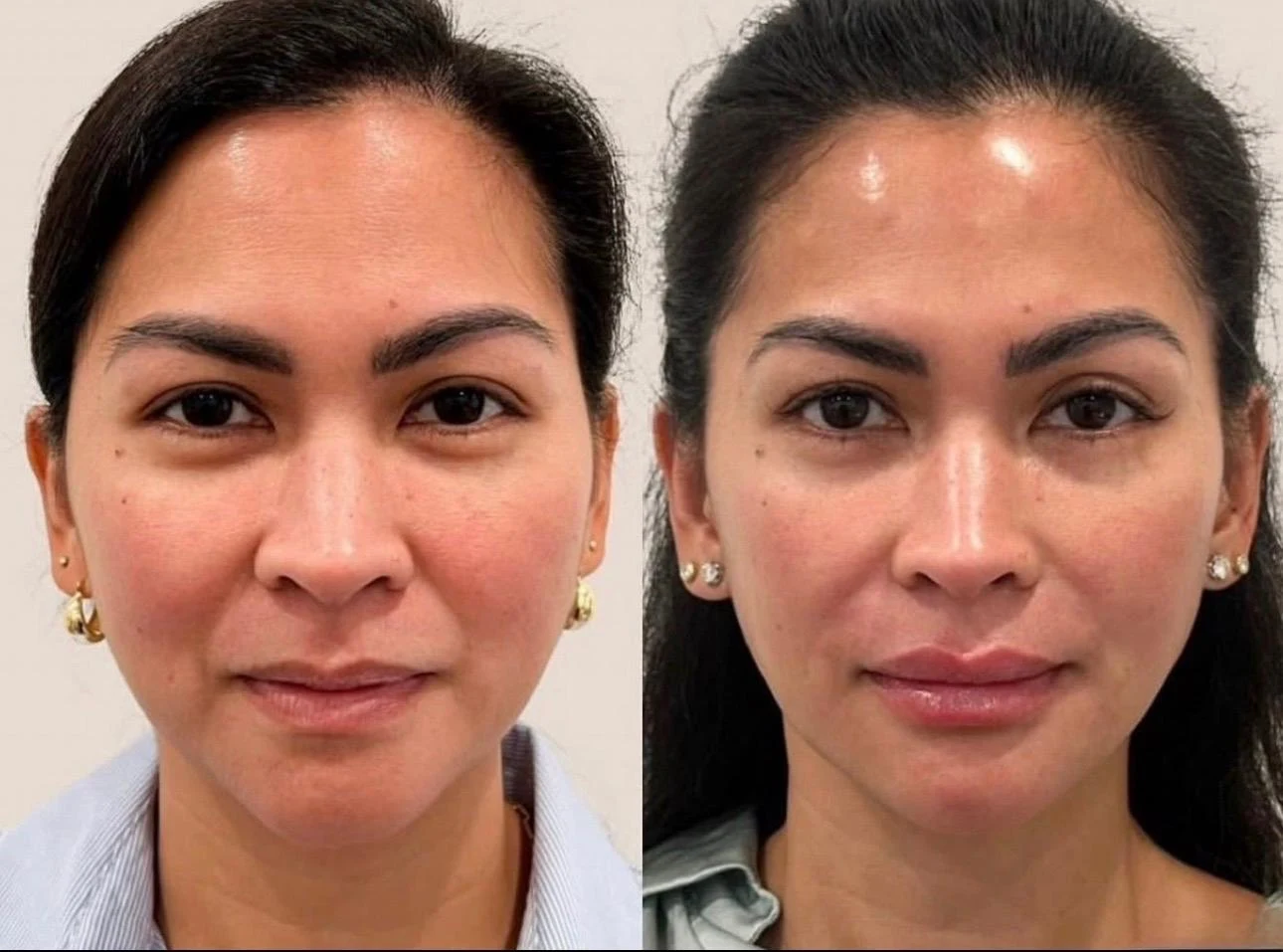 Fine lines and texture treatment result